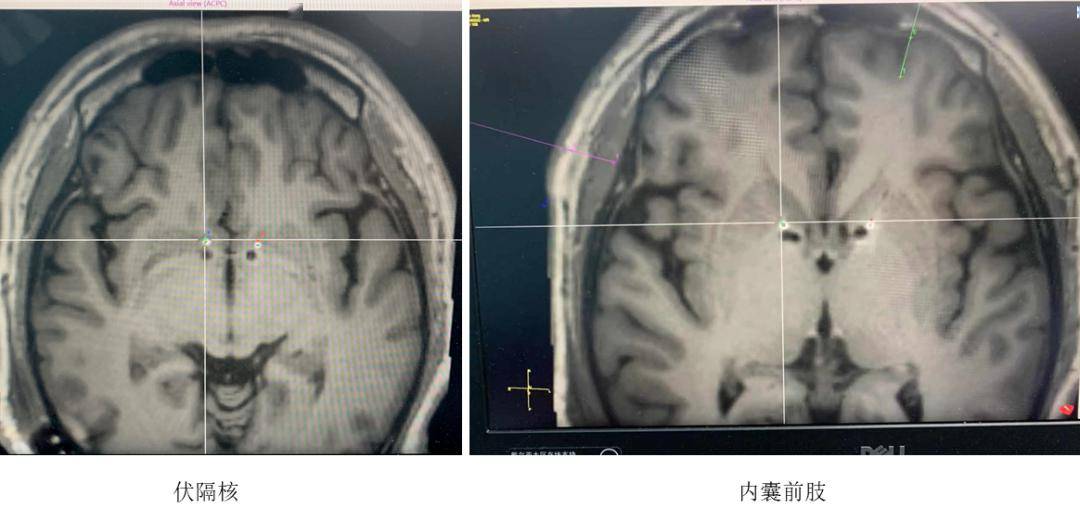 1.意大利电影胬肉治疗剧情解析