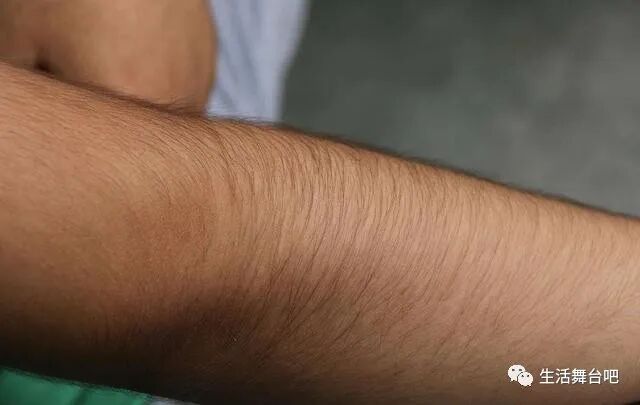 多毛体质困扰多时，这些脱毛技巧实测有效，告别尴尬不再难