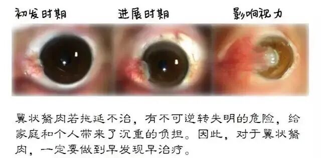 胬肉治疗免费观看浜浜浜胬肉治疗新方法，免费观看浜浜浜，快速治愈胬肉