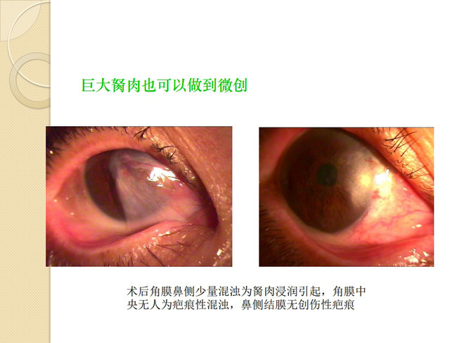 意大利胬肉治疗在线观看浜，专家解析最新疗法，轻松掌握康复技巧