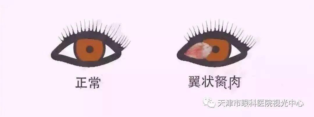 1.胬肉治疗新方法与临床研究进展