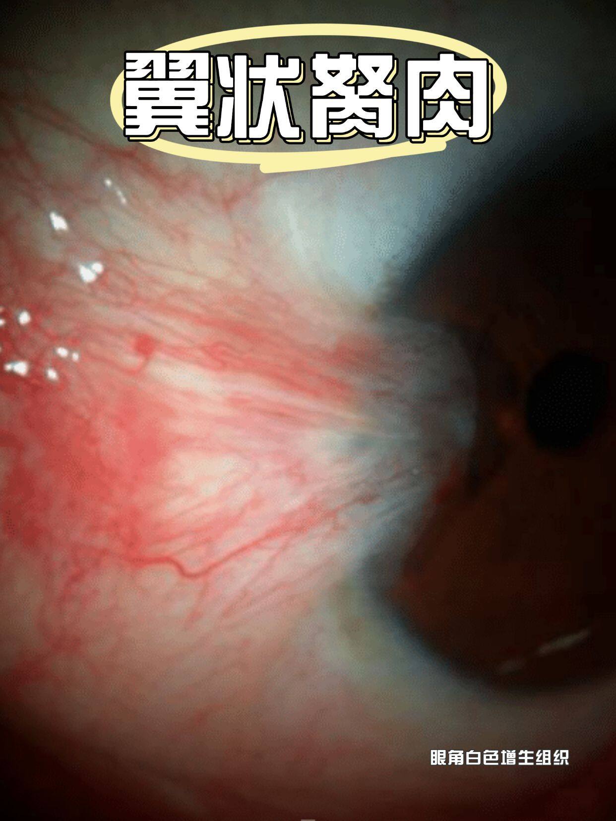 意大利胬肉治疗在线观看浜，专家解析最新疗法，轻松掌握康复技巧