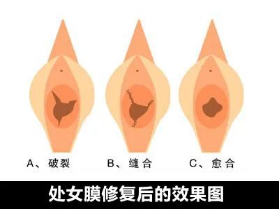 1.10～13岁女孩处女膜破裂毛片真相