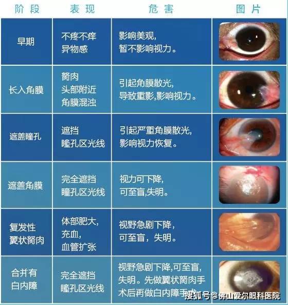 胬肉治疗免费观看浜浜浜胬肉治疗新方法，免费观看浜浜浜，快速治愈胬肉