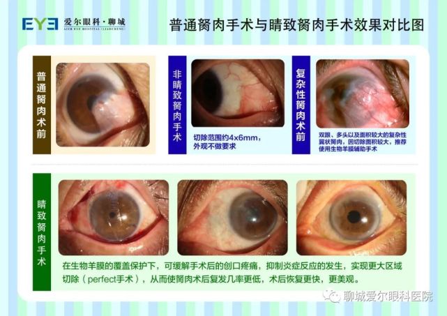 1.胬肉治疗新方法与临床研究进展