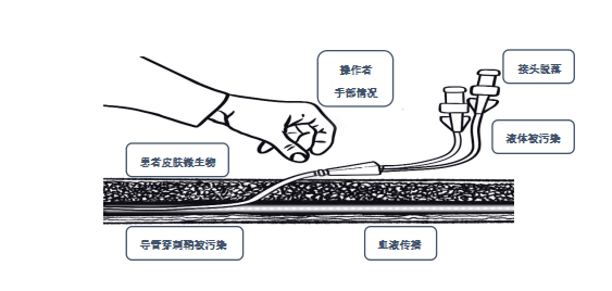脚导管专用产品选购指南，优质脚导管推荐，舒适安全必备