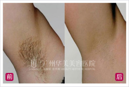脱毛A片必备技巧，轻松告别体毛困扰，展现光滑肌肤